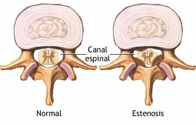 estenosis,canal,dolor,columna,vertebra.espalda,cojea,espasmos,pierna,fisioterpaeuta,fisio,osteopáta,quiropráctica,almería