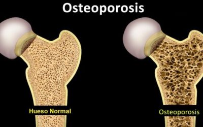 La Quiropráctica y la osteoporosis