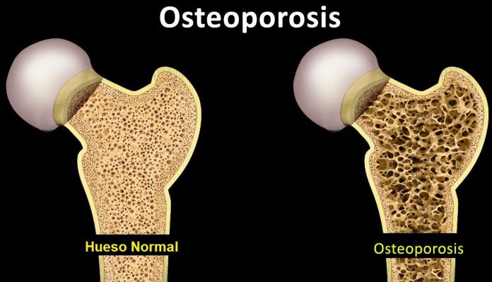 osteoporosis, huesos, artiuclaciones. dolor, espalda, medicina, salud, quiropráctica, almería